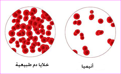 اسباب فقر الدم الانيميا الوقاية والعلاج