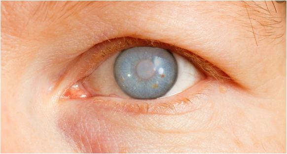 أعراض المياه الزرقاء للعين